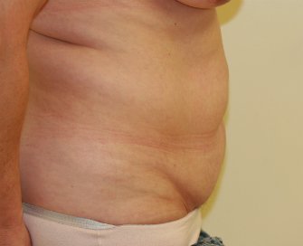 Tummy Tuck Case 17 - before - side