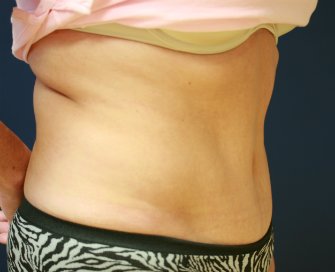 Tummy Tuck Case 17 - after - side