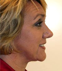 Necklift Case 3 - after - front