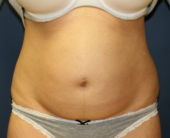 TummyTuckSanDiego Case 45 - before - front