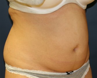 TummyTuckSanDiego Case 45 - before - oblique