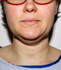 Necklift Case 4 - before - side
