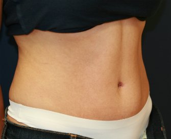TummyTuckSanDiego Case 45 - after - oblique