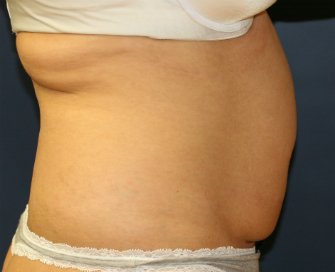 TummyTuckSanDiego Case 45 - before - side