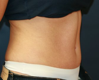 TummyTuckSanDiego Case 45 - after - side