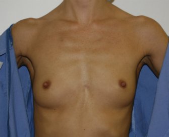 Breast Augmentation Case 23 - before - front