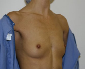 Breast Augmentation Case 23 - before - oblique
