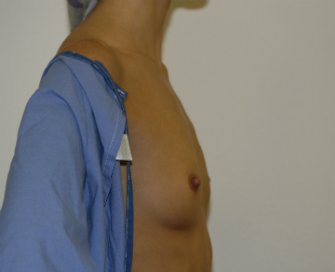 Breast Augmentation Case 23 - before - side