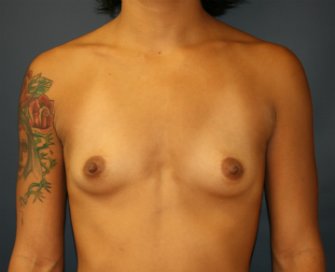 Breast Augmentation San Diego Case 77 - before - front