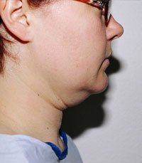 Necklift Case 4 - before - front