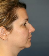 Rhinoplasty San Diego Case 36 - before - front