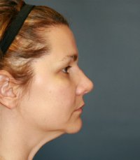 Rhinoplasty San Diego Case 36 - after - front