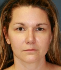 Rhinoplasty San Diego Case 36 - after - oblique
