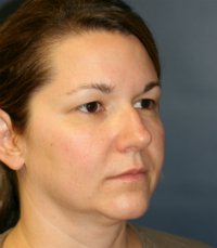 Rhinoplasty San Diego Case 36 - before - side