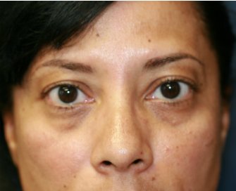Radiesse filler in lower eyelids - before - front