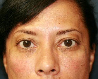 Radiesse filler in lower eyelids - after - front