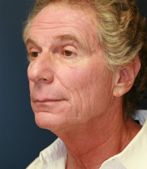 facelift-san-diego-case-24 - before - oblique