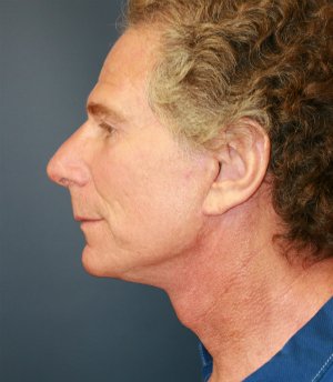 facelift-san-diego-case-24 - after - side