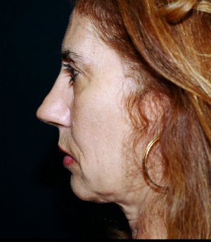Facelift-San-Diego-Case-1 - before - side