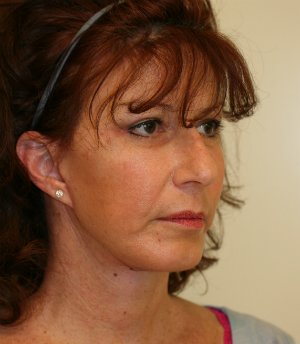 Facelift-San-Diego-Case-2 - after - oblique