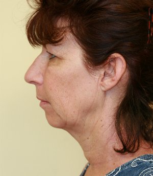 Facelift-San-Diego-Case-2 - before - side