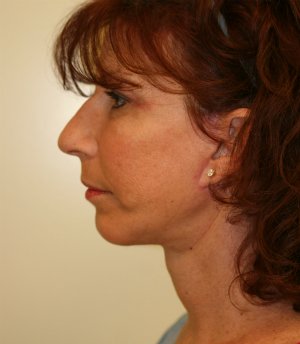 Facelift-San-Diego-Case-2 - after - side