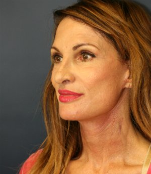 Facelift-San-Diego-Case-23 - after - oblique