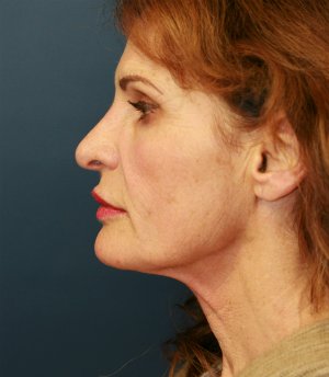 Facelift-San-Diego-Case-23 - before - side