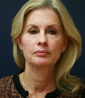 Facelift-San-Diego-Case-16 - before - front