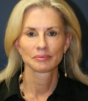 Facelift-San-Diego-Case-16 - after - front
