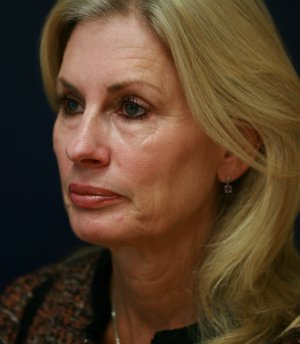 Facelift-San-Diego-Case-16 - before - oblique