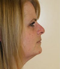 Necklift Case 5 - before - front