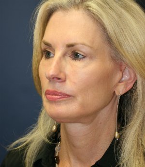 Facelift-San-Diego-Case-16 - after - oblique