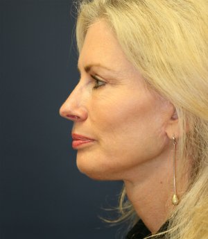Facelift-San-Diego-Case-16 - after - side