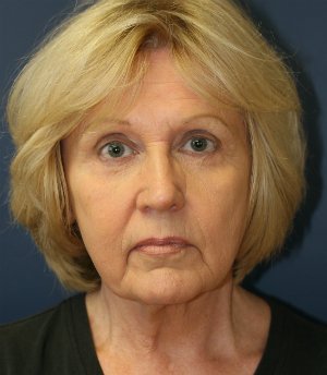 No makeup after 6 weeks - before - front