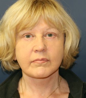 No makeup after 6 weeks - after - front