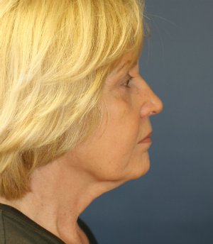 No makeup after 6 weeks - before - side