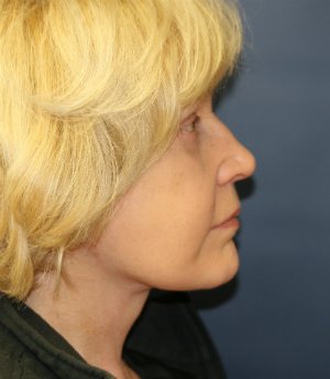 No makeup after 6 weeks - after - side