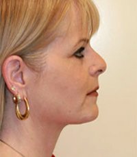 Necklift Case 5 - after - front
