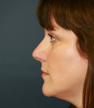 Rhinoplasty San Diego 37 - before - front