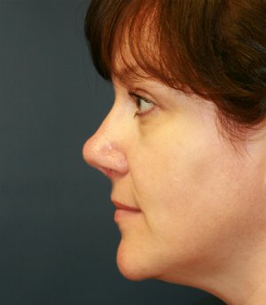 Rhinoplasty San Diego 37 - after - front