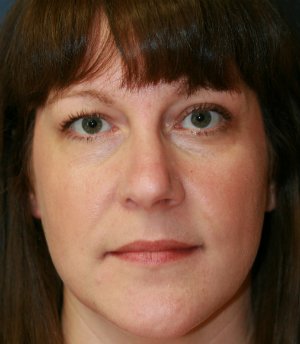Rhinoplasty San Diego 37 - before - side
