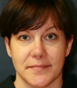 Rhinoplasty San Diego 37 - after - side