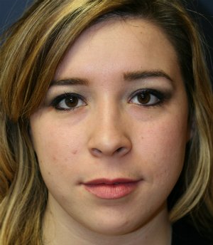 Tip Rhinoplasty 39 - before - front
