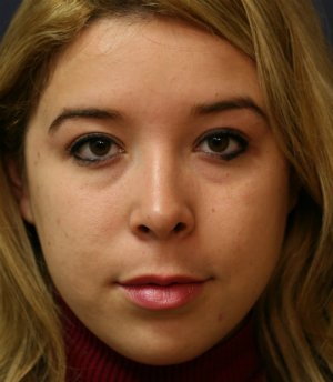 Tip Rhinoplasty 39 - after - front