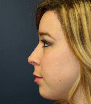 Tip Rhinoplasty 39 - before - side