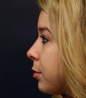 Tip Rhinoplasty 39 - after - side