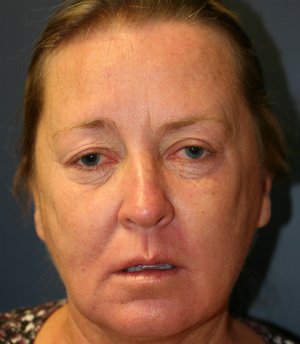 Eyelid Surgery San Diego 51 - before - front
