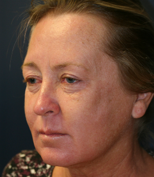 Eyelid Surgery San Diego 51 - before - oblique
