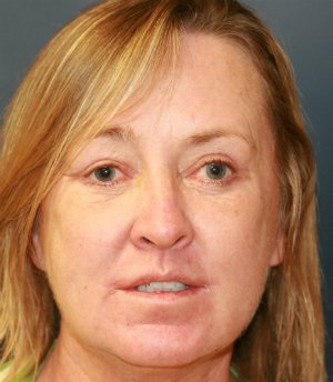 Lip Lift San Diego 19 - after - front